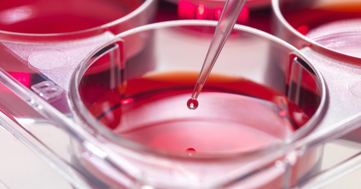 O nouă descoperire în domeniul tratamentului leucemiei mieloide acute (LMA) ar putea deschide calea către terapii mai eficiente, personalizate în funcție de profilul biologic al fiecărui pacient