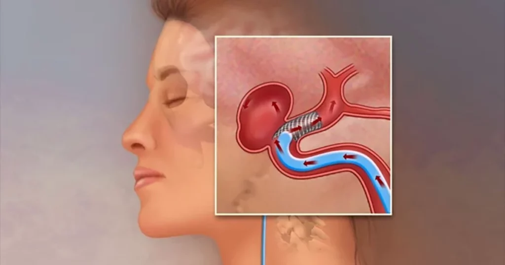 Medicul neurolog atrage atenția: semnele timpurii ale anevrismului cerebral, potențial letal, nu trebuie ignorate Când vine vorba de sănătatea creierului, o simplă durere de cap sau anumite senzații neobișnuite pot ascunde probleme grave, uneori cu consecințe dezastruoase