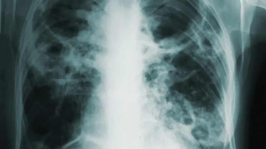 Romania marchează Ziua Mondială de Luptă Împotriva Tuberculozei prin iluminarea Arcului de Triumf în roșu și campanii de conștientizare Pentru a evidenția problema tot mai acută a tuberculozei în țara noastră, Centrul de Cultură „Palatele Brâncovenești” în colaborare cu Primăria Municipiului București a organizat un eveniment simbolic marcat prin iluminarea Arcului de Triumf în culoarea roșu, în seara de 24 martie