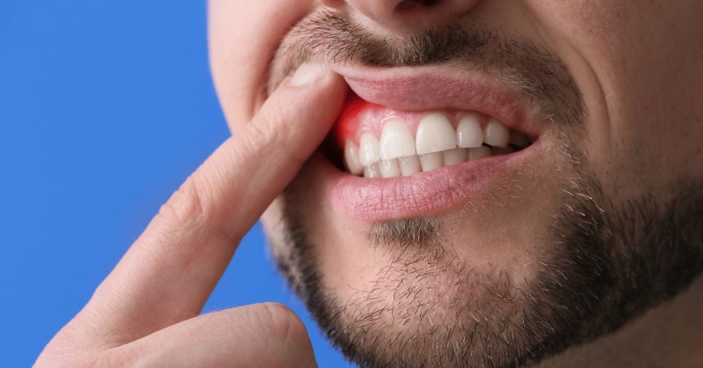 Gingiile roșii, sângele, respirația urât mirositoare și o peliculă albicioasă pe limbă – simptome frecvent ignorate sau tratate superficial – ar putea ascunde mai mult decât simple probleme de igienă orală