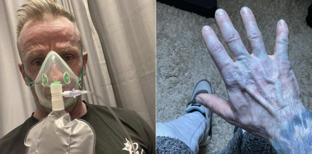 Un bărbat de 42 de ani a stârnit rumoare după ce a fost adus de urgență la spital, în stare de panică, după ce s-a trezit cu pielea acoperită complet cu o nuanță albastrie intensă