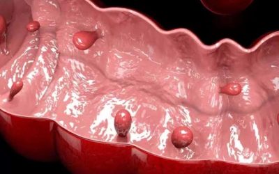 Polipul sesil din colon, riscuri și semne de transformare malignă