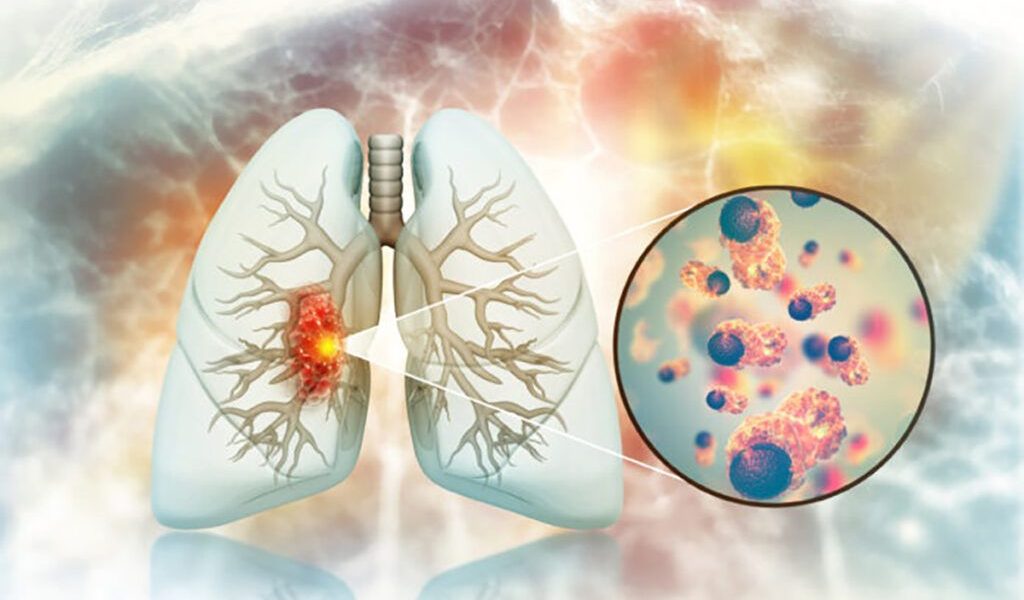 Cancerul pulmonar la nefumători: Legătură surprinzătoare cu fructele și legumele