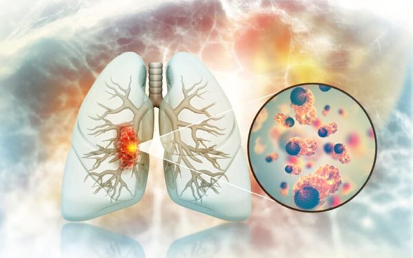Cancerul pulmonar la nefumători: Legătură surprinzătoare cu fructele și legumele