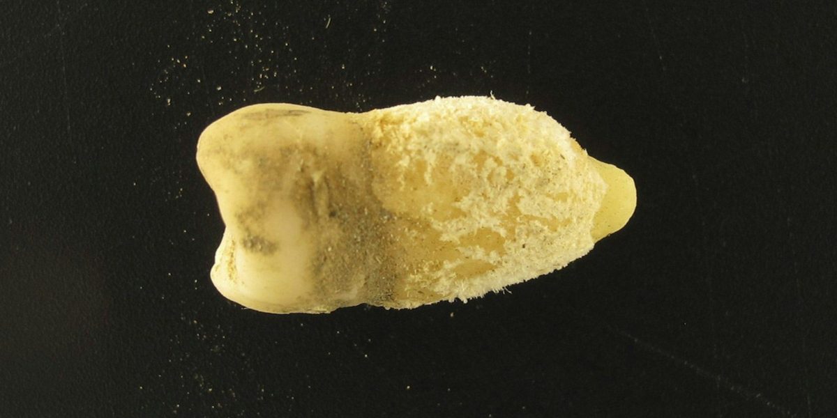 Bacterie ucigașă din scarlatină, găsită într-o mumie! Descoperirea uluitoare