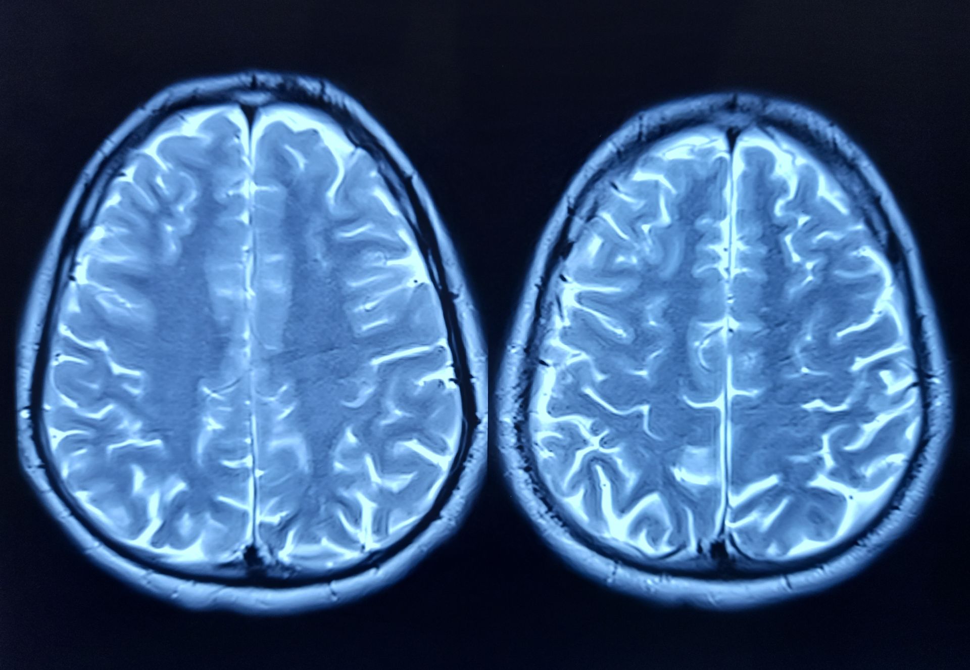 O proteină implicată în declinul cognitiv al creierului bătrânilor Cercetătorii au identificat o proteină numită FTL1, care pare să fie un factor cheie în procesul de îmbătrânire a creierului