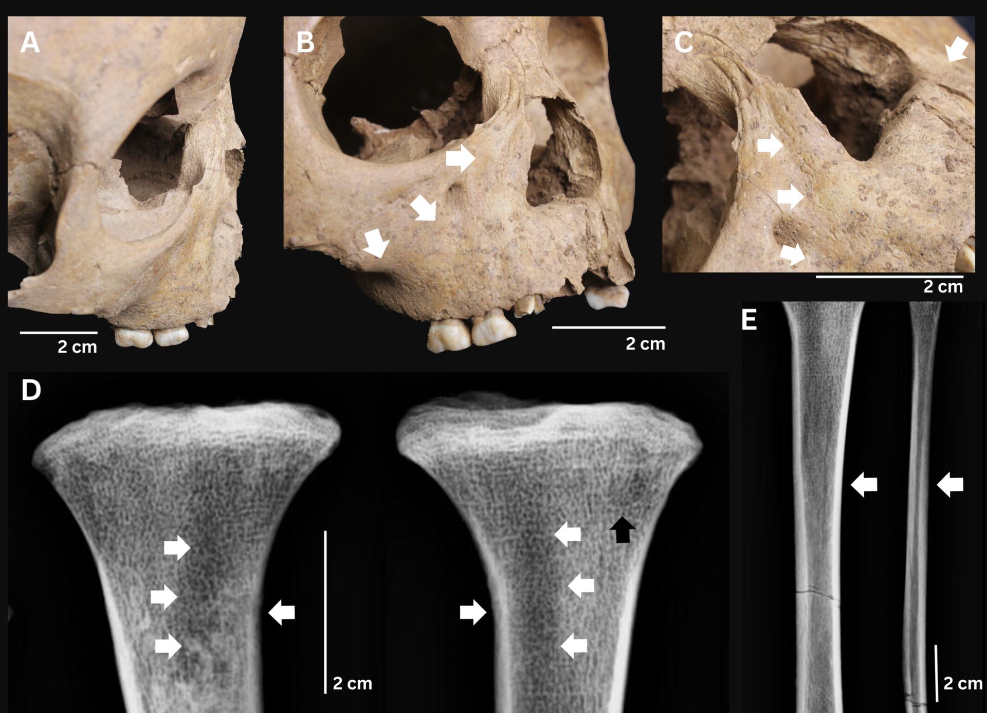 Arheologii din Vietnam au făcut o descoperire care ar putea modifica în întregime înțelesul despre originea sifilisului