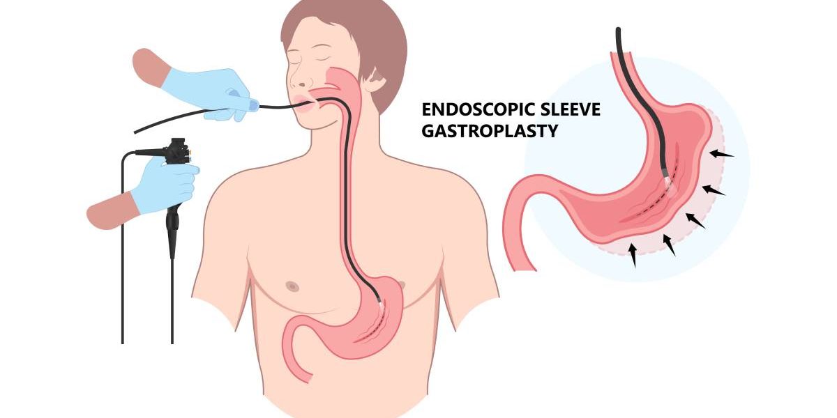 EȘEC garantat la dietă? O nouă metodă, fără bisturiu, te scapă de kilograme