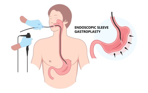 EȘEC garantat la dietă? O nouă metodă, fără bisturiu, te scapă de kilograme