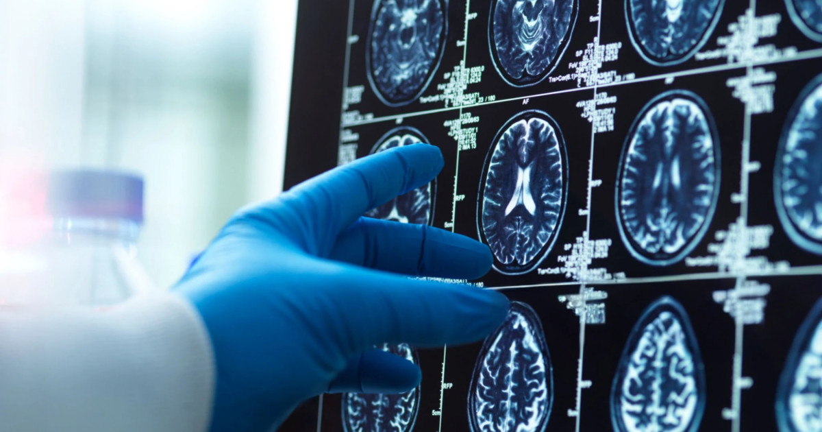 A apărut prima hartă detaliată a creierului uman în domeniul îmbătrânirii, cu accent pe zonele cele mai vulnerabile în fața Alzheimer