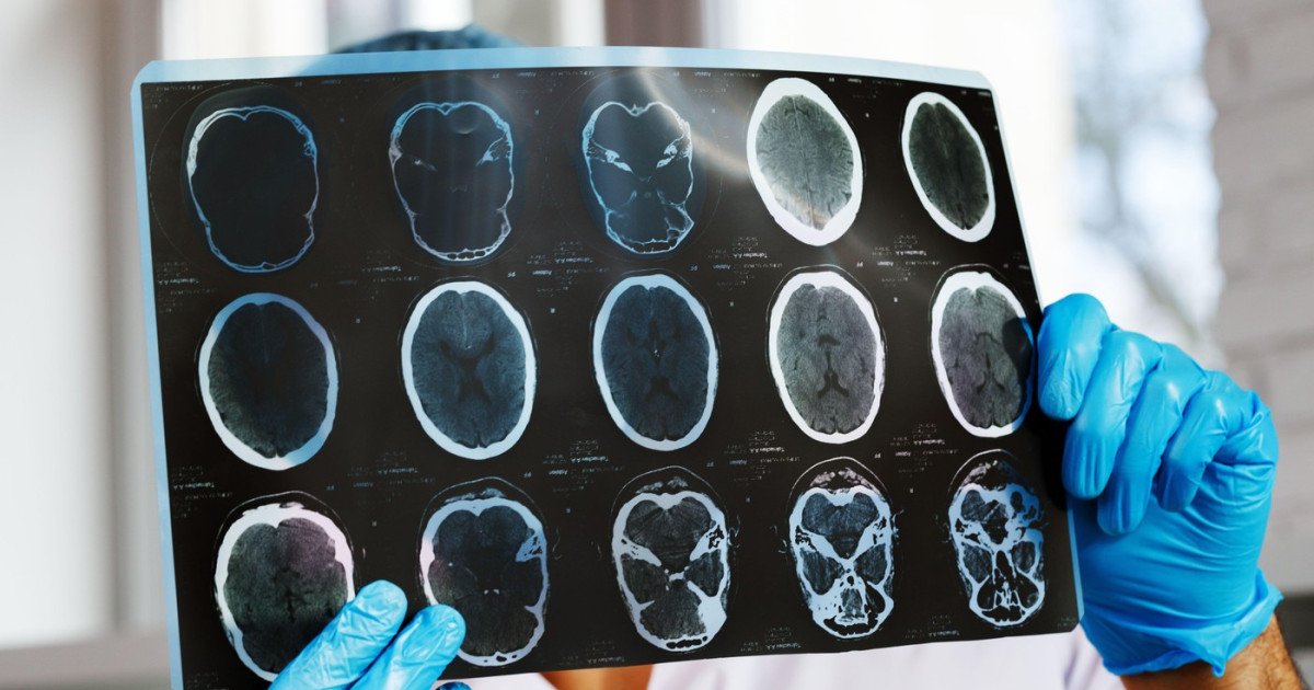 Organizațiile de pacienți solicită intervenția urgentă a autorităților după o scădere dramatică a monitorizării pentru pacienții cu afecțiuni cronice Mai multe organizații de pacienți din România cer Ministerului Sănătății și Casei Naționale de Asigurări de Sănătate (CNAS) o intervenție rapidă, după ce datele recente arată o reducere cu aproape 47% a numărului de investigații de monitorizare de înaltă performanță pentru pacienții cu boli cronice într-o singură lună