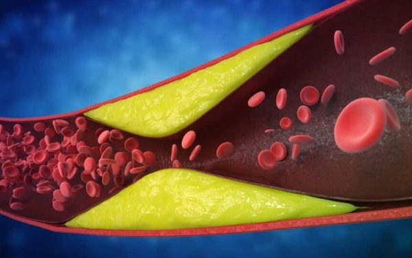 7 semne cruciale de artere blocate: Ce ignoră mulți români și de ce