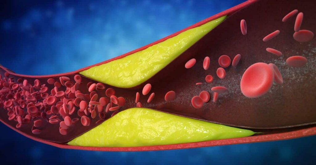 7 semne cruciale de artere blocate: Ce ignoră mulți români și de ce