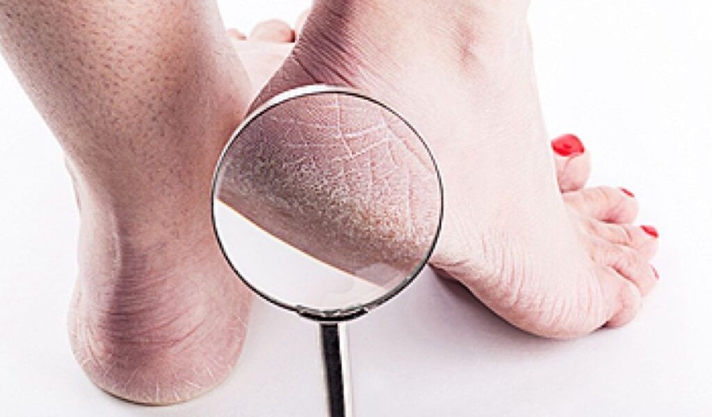 Culoarea călcâielor, semn de boală gravă? Medicul avertizează înainte de analize