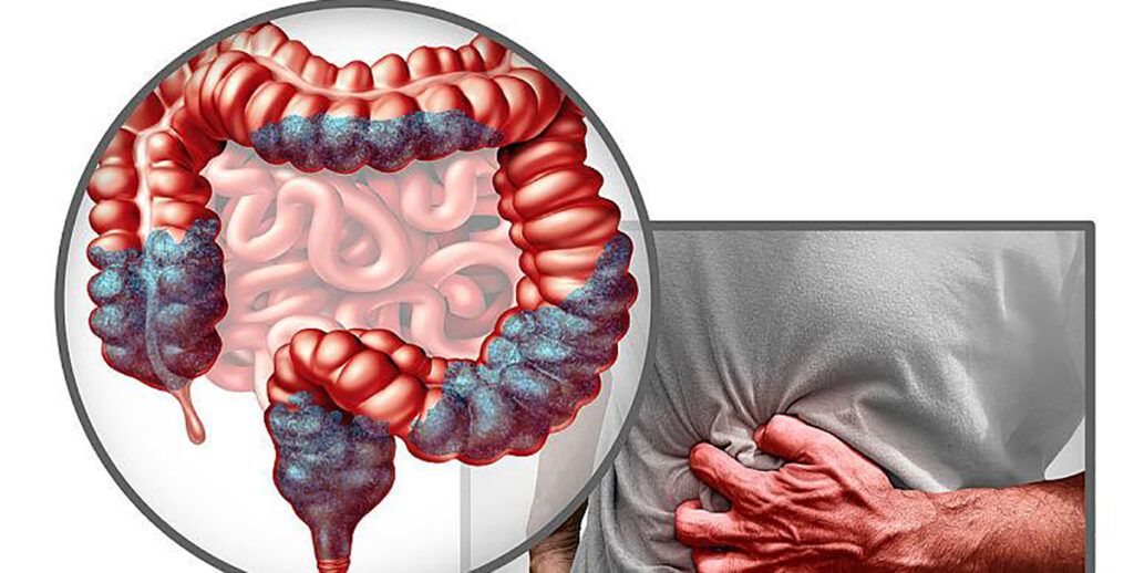 Aproape jumătate dintre adulți nu sunt conștienți de legătura dintre consumul anumitor alimente și riscul de cancer colorectal