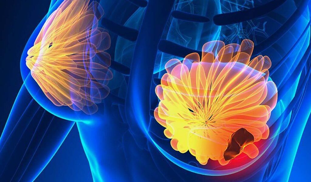 Semne ale cancerului de sân: 5 simptome la care să fii atentă