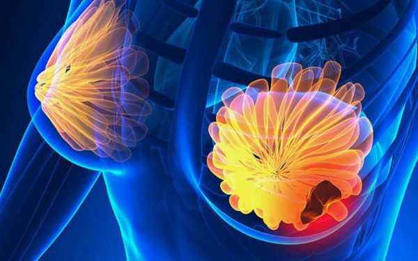 Semne ale cancerului de sân: 5 simptome la care să fii atentă
