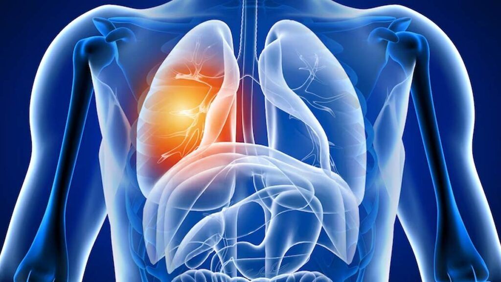 ȘOCANT: Ce efecte ascunse lasă COVID-19 în plămâni