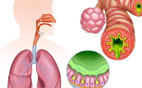Inflamția cronică, inamicul ascuns: Atacă sănătatea modernă, avertizează specialiștii