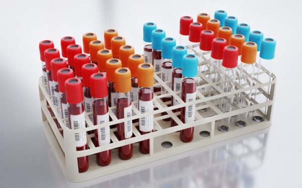 Analiza sângelui: Noul test care depășește colesterolul, depistează infarctul