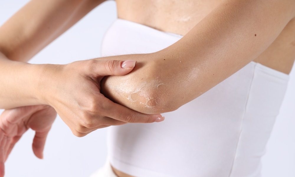 Piele uscată pe brațe și picioare? 5 obiceiuri care agresează epiderma