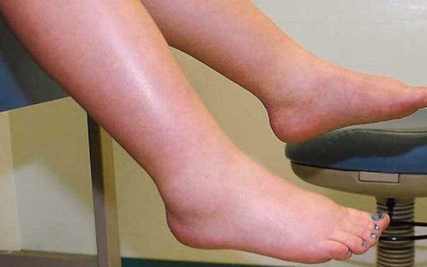 Leguma minune: Spune ADIO picioarelor umflate și circulației proaste!