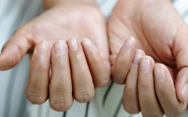 Unghiile Terry, semnal de alarmă: ce boli grave pot ascunde?