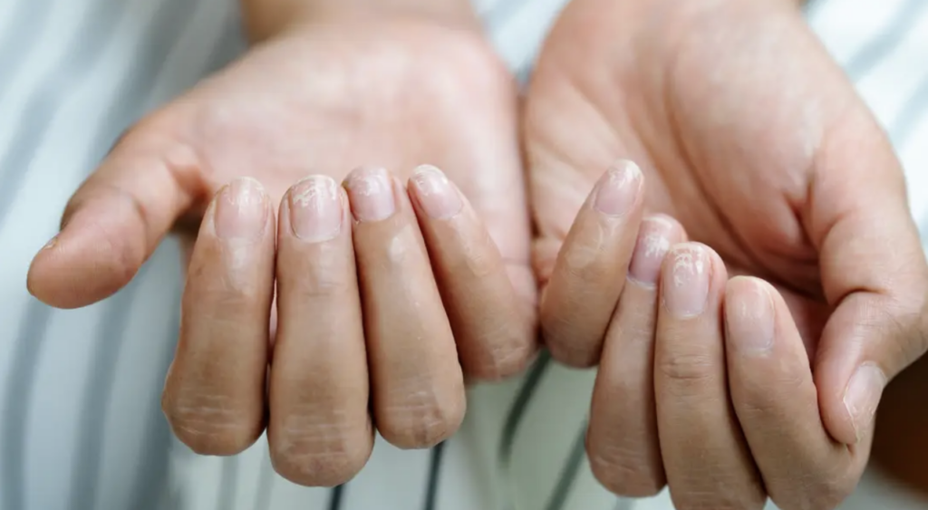 Unghiile Terry, semnal de alarmă: ce boli grave pot ascunde?