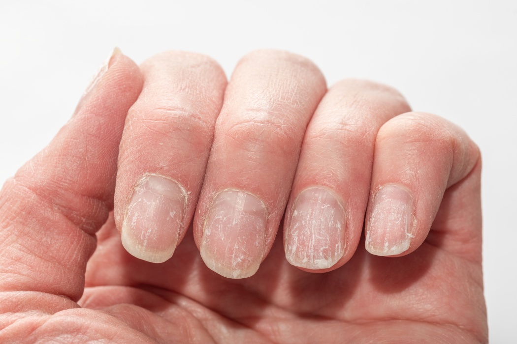 Modificările de la nivelul unghiilor pot indica probleme de sănătate grave, ce depășesc aspectul estetic
