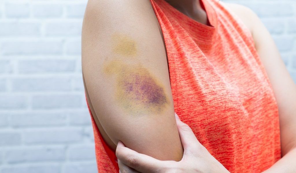 Vânătăi misterioase: Ai aceste semne? Mergi URGENT la doctor