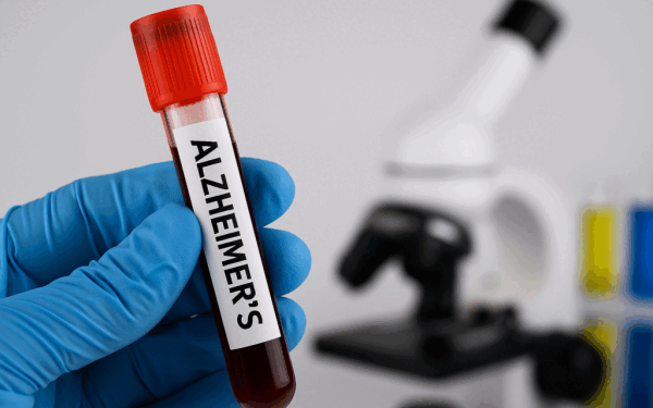 Alzheimer, transmisibil prin sânge? Șocul unui nou studiu