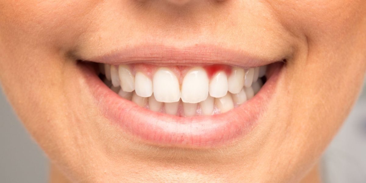 Gingiile sângerează: alerta roșie pentru boli grave