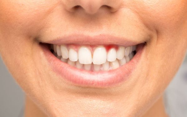 Gingiile sângerează: alerta roșie pentru boli grave