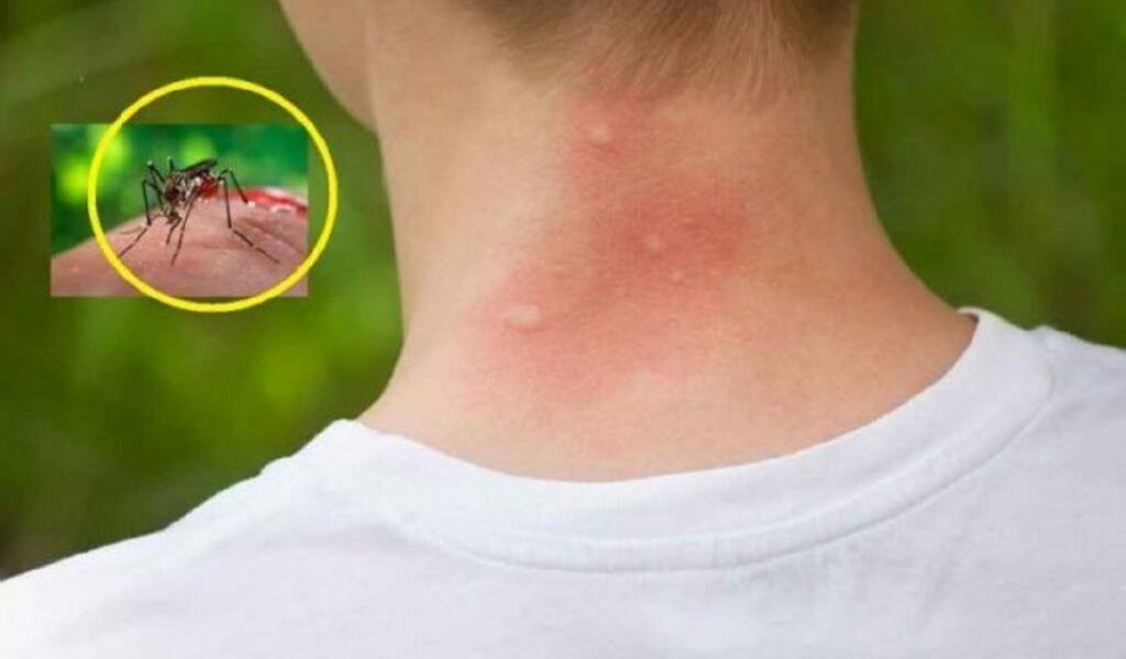 Țânțarii te înțeapă mai des: iată cele 3 bacterii care îi atrag