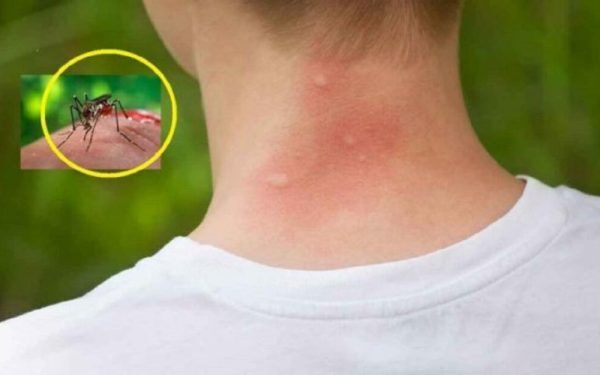 Țânțarii te înțeapă mai des: iată cele 3 bacterii care îi atrag