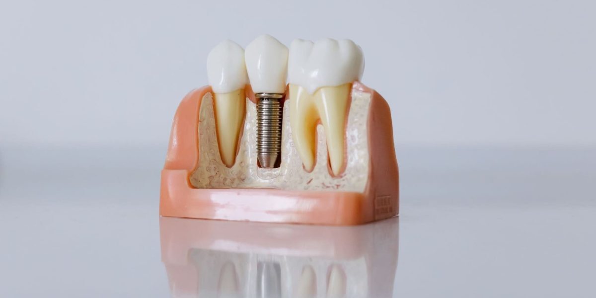 Osteointegrarea: Ce presupune și de ce implică luni de așteptare